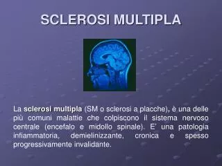 sclerosi multipla