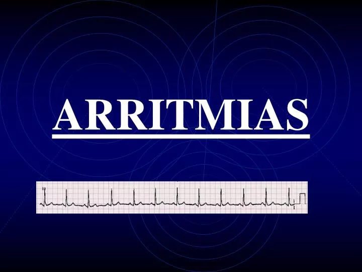 arritmias