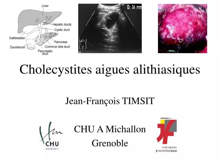 cholecystites aigues alithiasiques