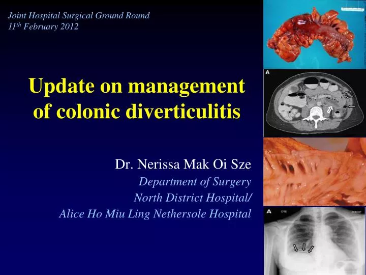 update on management of colonic diverticulitis