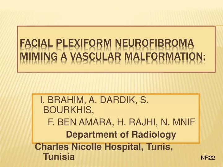 facial plexiform neurofibroma miming a vascular malformation