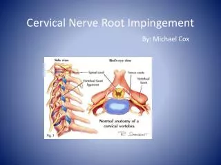 Cervical Nerve Root Impingement By: Michael Cox