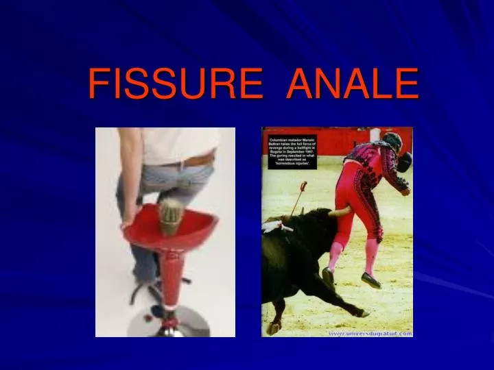 fissure anale