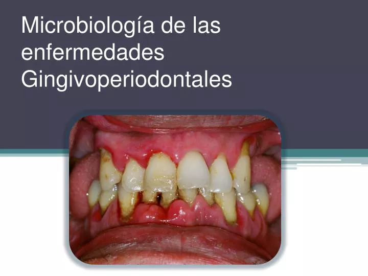 microbiolog a de las enfermedades gingivoperiodontales