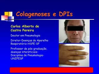 Colagenoses e DPIs