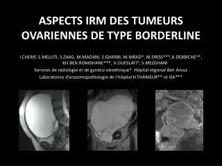 aspects irm des tumeurs ovariennes de type borderline