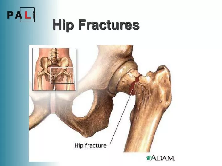hip fractures
