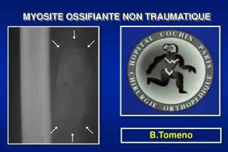 myosite ossifiante non traumatique