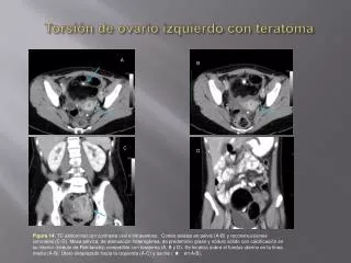 Torsión de ovario izquierdo con teratoma