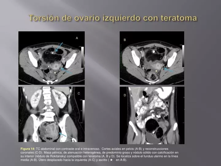 torsi n de ovario izquierdo con teratoma