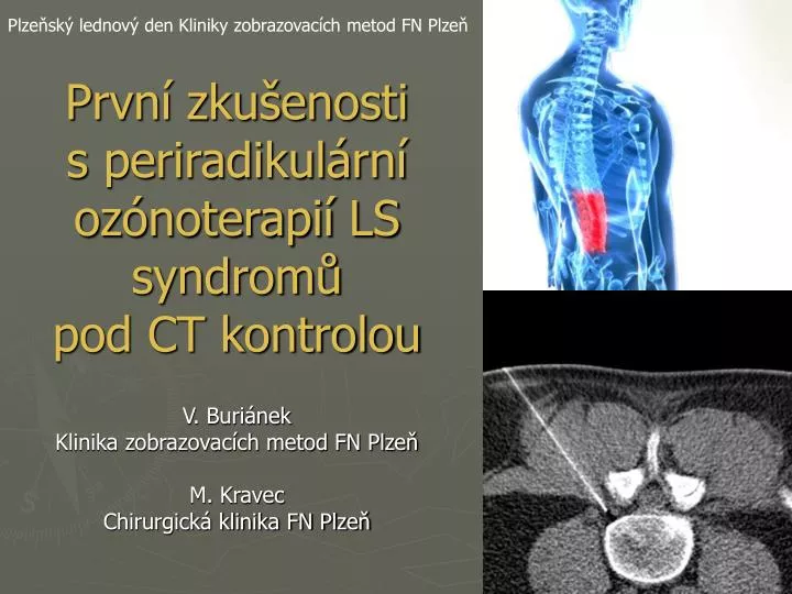 prvn zku enosti s periradikul rn oz noterapi ls syndrom pod ct kontrolou