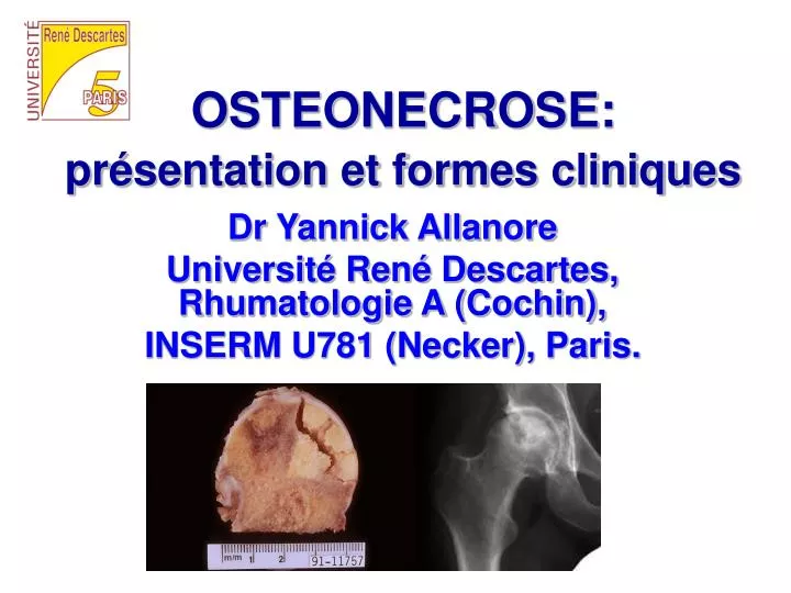 osteonecrose pr sentation et formes cliniques