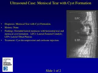 Ultrasound Case: Meniscal Tear with Cyst Formation