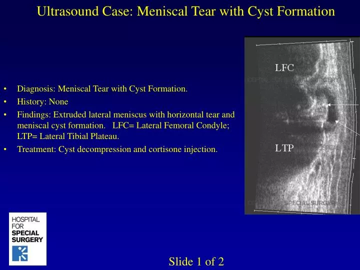 ultrasound case meniscal tear with cyst formation