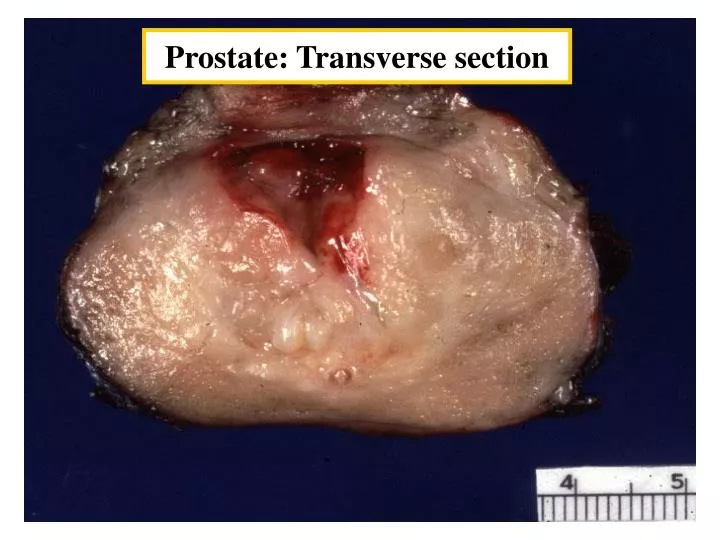 prostate transverse section