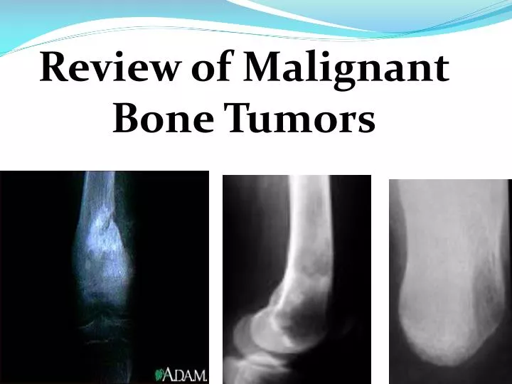 review of malignant bone tumors