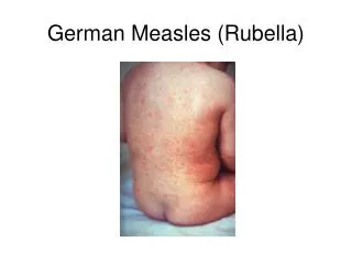 German Measles (Rubella)
