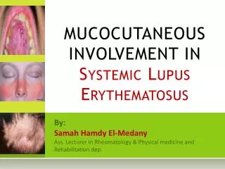MUCOCUTANEOUS INVOLVEMENT IN Systemic Lupus Erythematosus