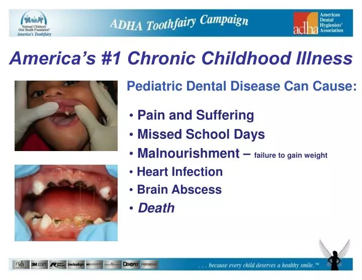 pediatric dental disease can cause