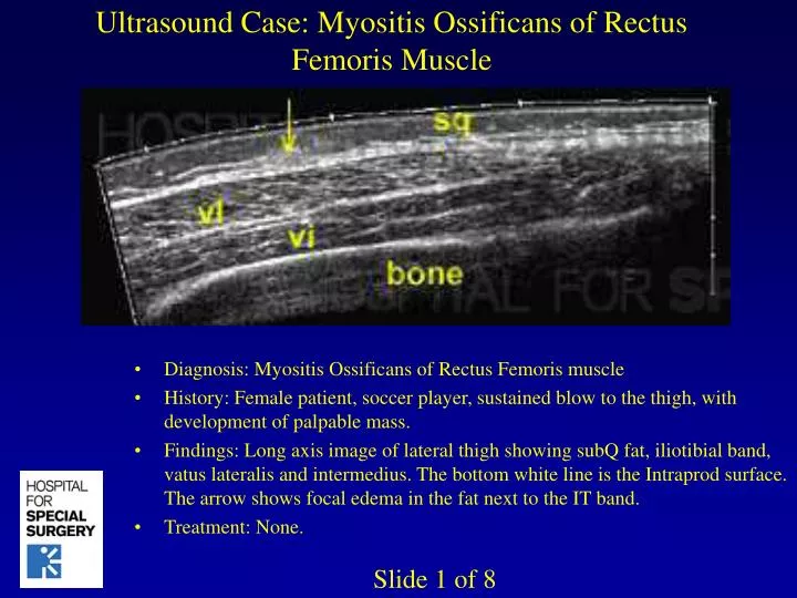 ultrasound case myositis ossificans of rectus femoris muscle