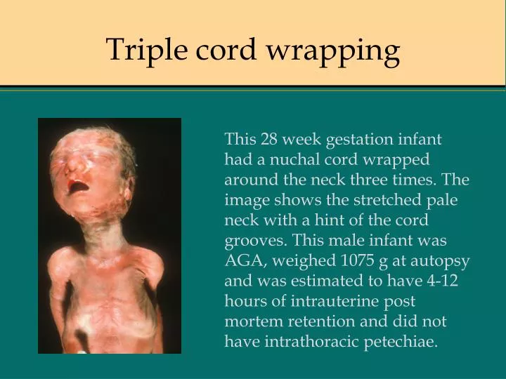 triple cord wrapping