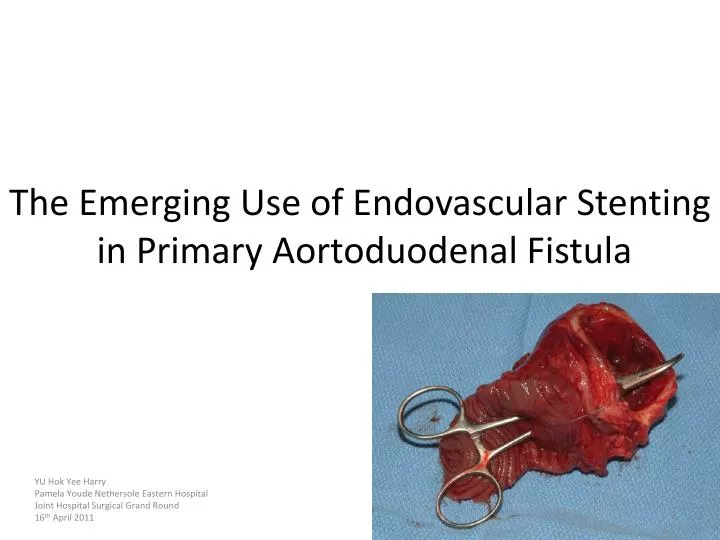 the emerging use of endovascular stenting in primary aortoduodenal fistula