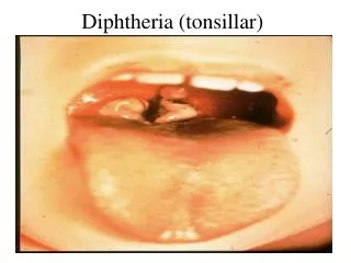 Diphtheria (tonsillar)