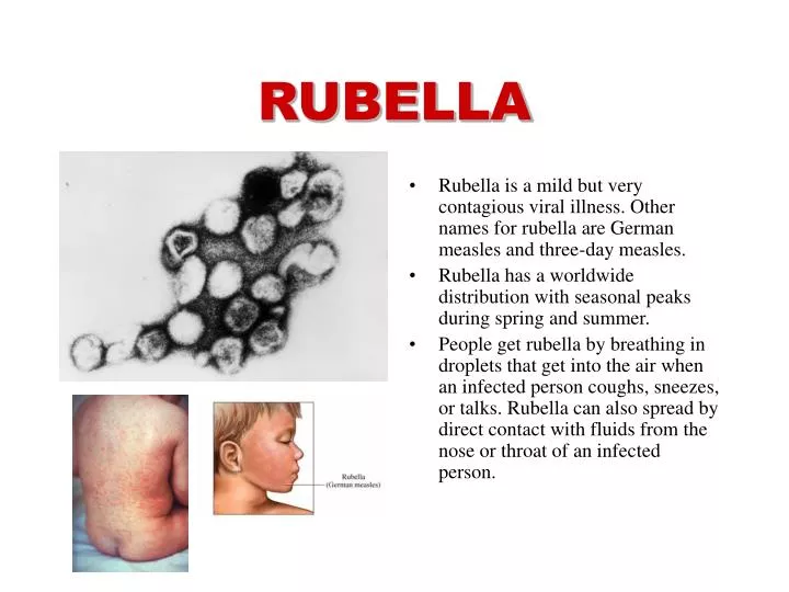 rubella