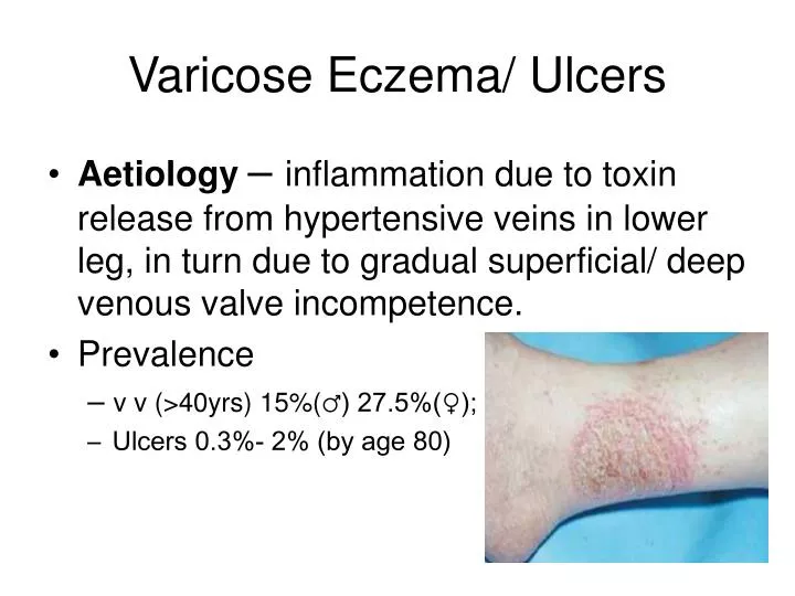 varicose eczema ulcers