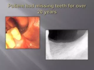 Patient had missing teeth for over 20 years