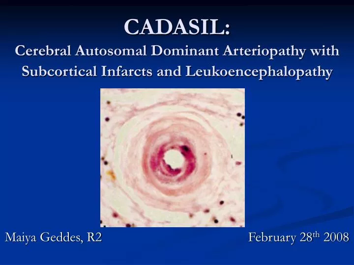 cadasil cerebral autosomal dominant arteriopathy with subcortical infarcts and leukoencephalopathy