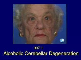 Alcoholic Cerebellar Degeneration