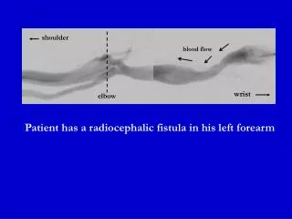 Patient has a radiocephalic fistula in his left forearm