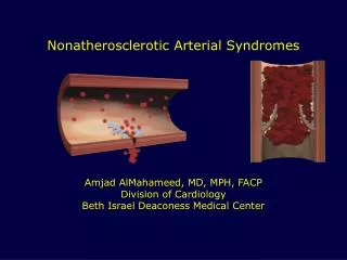 Nonatherosclerotic Arterial Syndromes Amjad AlMahameed, MD, MPH, FACP Division of Cardiology Beth Israel Deaconess Medic