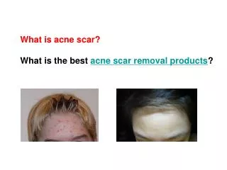 2011 best zenmed acne scar removal products