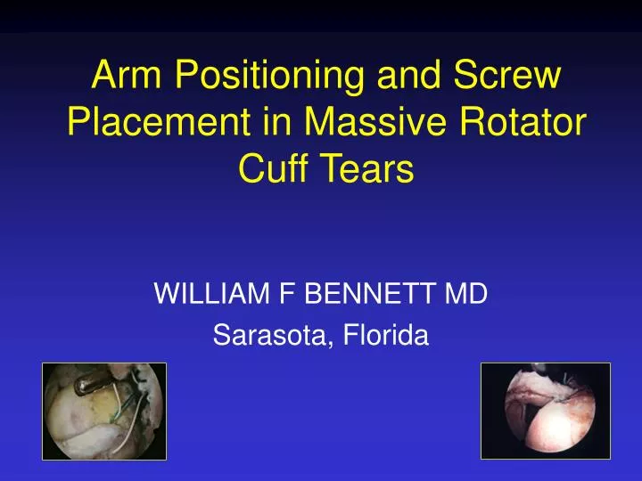 arm positioning and screw placement in massive rotator cuff tears