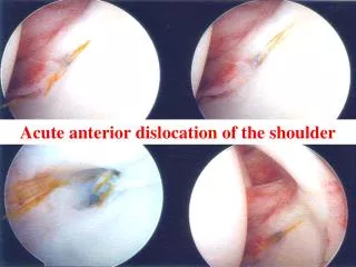 Acute anterior dislocation of the shoulder