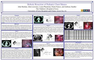 Robotic Resection of Pediatric Chest Masses John Meehan, John Lawrence, Laura Phearman, Paula Francis, and Anthony Sandl