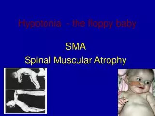 Hypotonia - the floppy baby