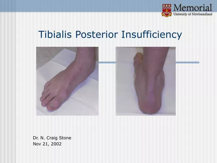 tibialis posterior insufficiency