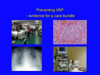 Preventing VAP - evidence for a care bundle