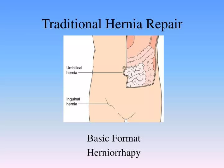 traditional hernia repair