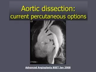 Aortic dissection: current percutaneous options