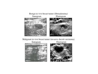 Benign in vivo breast tumor (fibroadenoma) Sonogram Elastogram