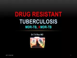Multidrug resistant tuberculosis