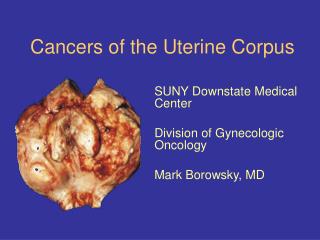 Cancers of the Uterine Corpus
