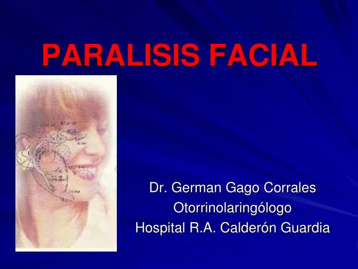 paralisis facial