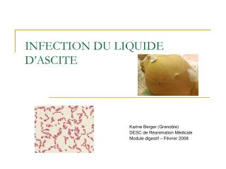 INFECTION DU LIQUIDE D’ASCITE