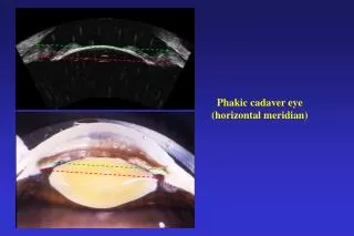 Phakic cadaver eye (horizontal meridian)
