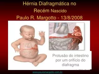 Hérnia Diafragmática no Recém Nascido Paulo R. Margotto - 13/8/2008